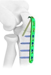 Ліктьова пластина ІІІ ( Double Medical Technology Inc.)